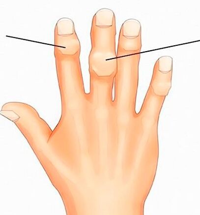 Heberdeno ir Bouchard mazgai tarpfalanginiuose sąnariuose su artroze