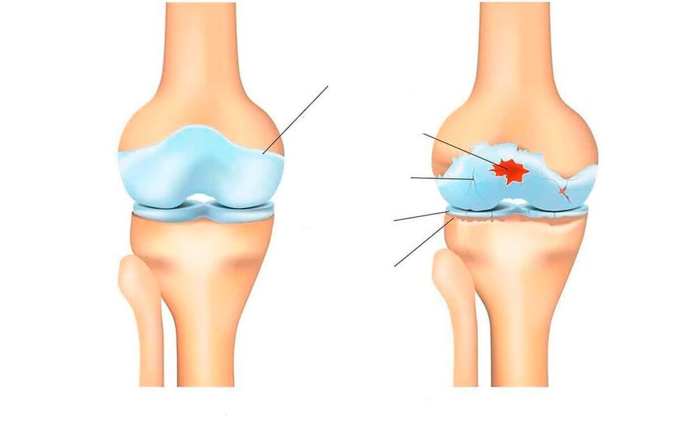 sveikas sąnarys ir artroze