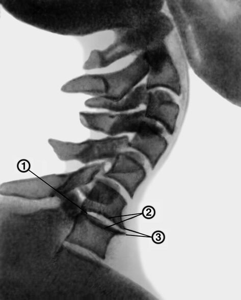 Kaklo stuburo rentgenograma su osteochondroze