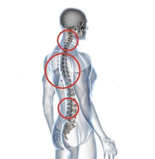 Kaip pasireiškia osteochondrozė