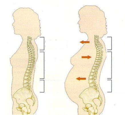 Osteochondrozė nėštumo metu