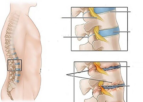 diskų pokyčiai dėl osteochondrozės